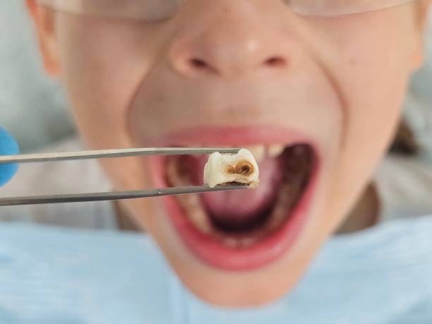 Best Emergency Treatment for Toothache in Strafford, MO